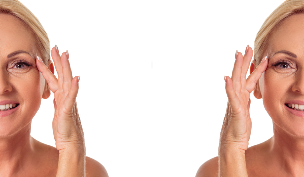 Kırışıklık Tedavisi Kesler Clinic